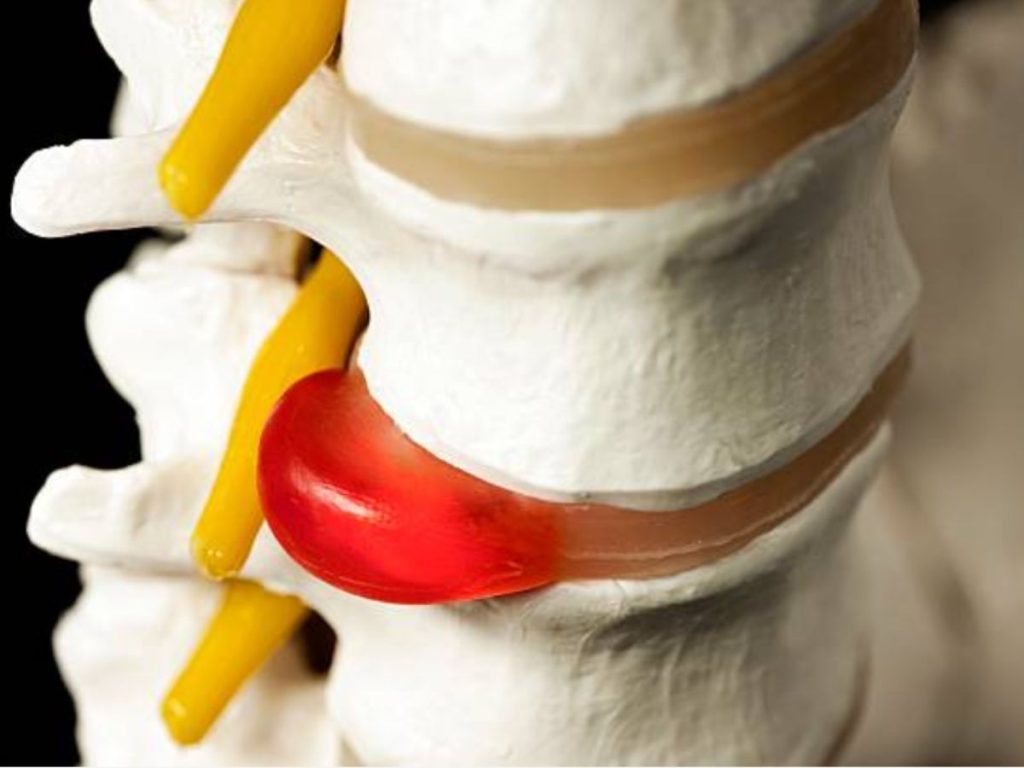 Hernia discal en la columna presionando un nervio