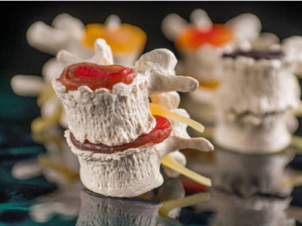 Modelo de columna mostrando una hernia discal
